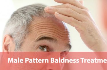 Male-Pattern-Baldness-Treatments