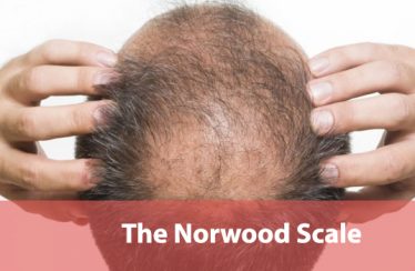 The-Norwood-Scale