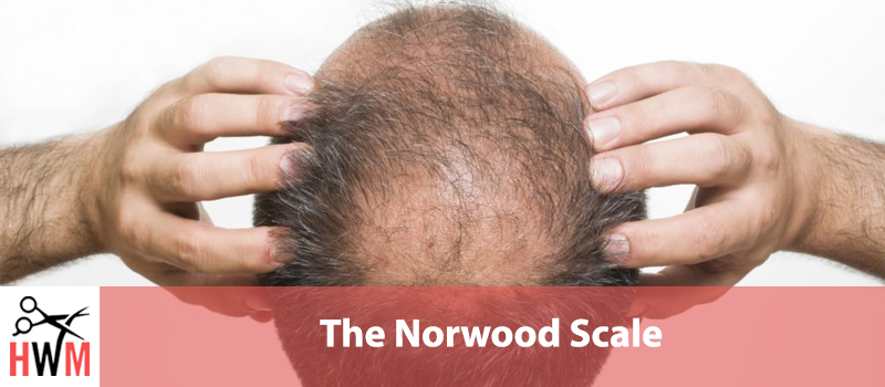 What Is The Norwood Scale & How Bald Are You?