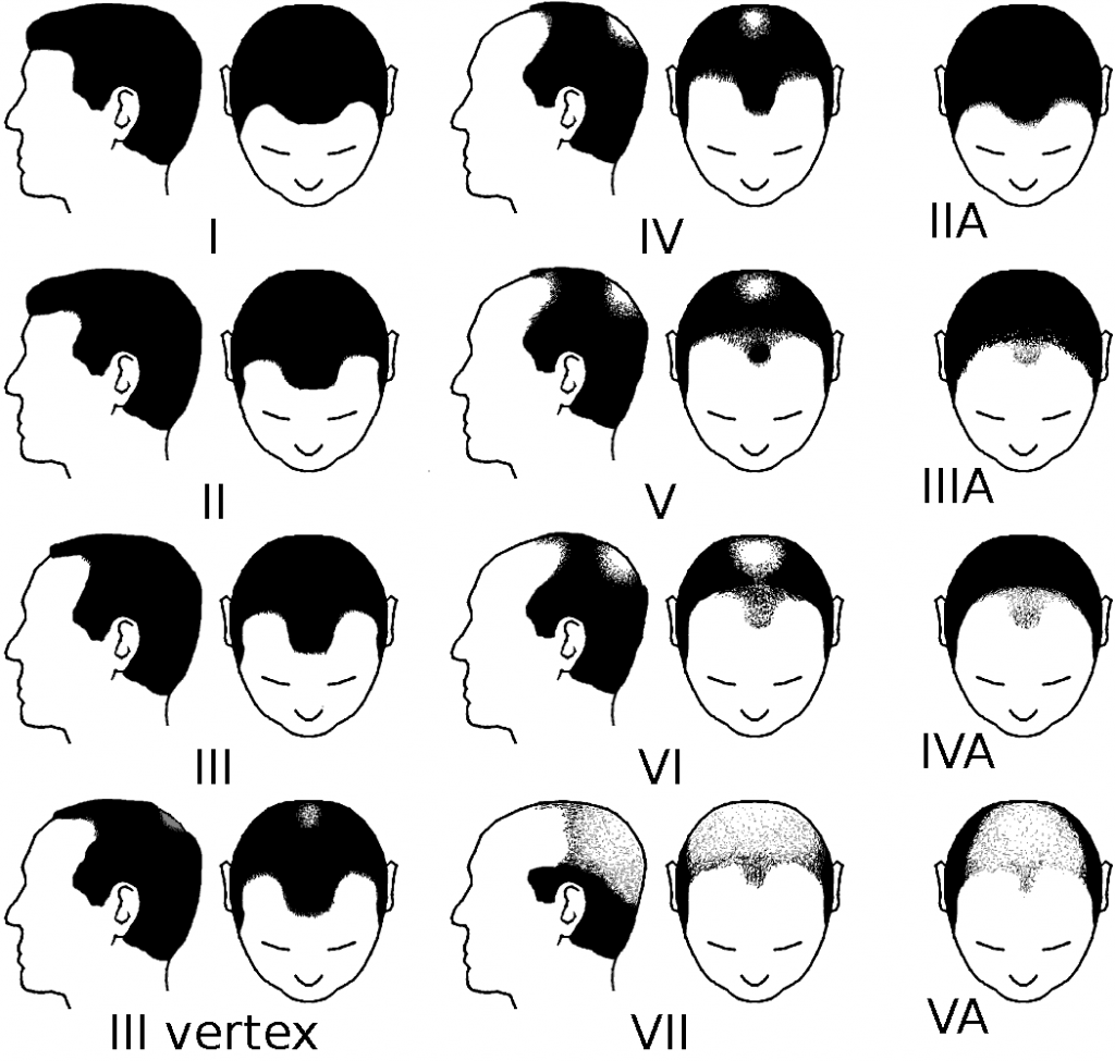 norwood-balding-scale