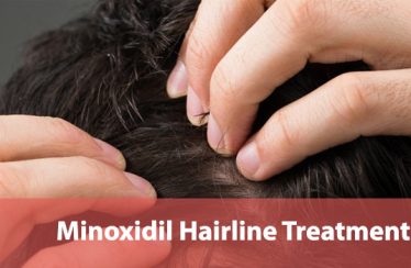 Best-Minoxidil-Hairline-Treatments