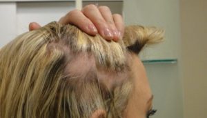 Effectively Prevent Traction Alopecia