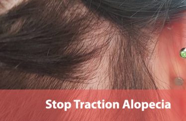 How to Stop Traction Alopecia