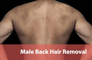 Male Back Hair Removal