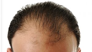 What Kinds of Hair Loss is Rogaine Good For