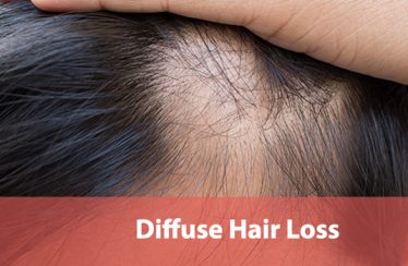 Diffuse Hair Loss