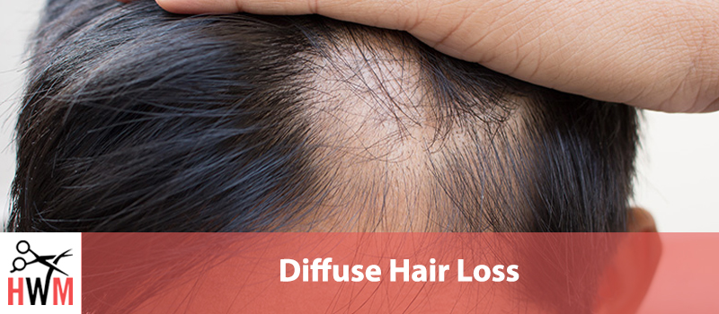 Diffuse Hair Loss