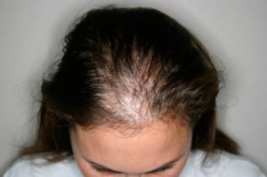 Easy Signs of Diffuse Hair Loss