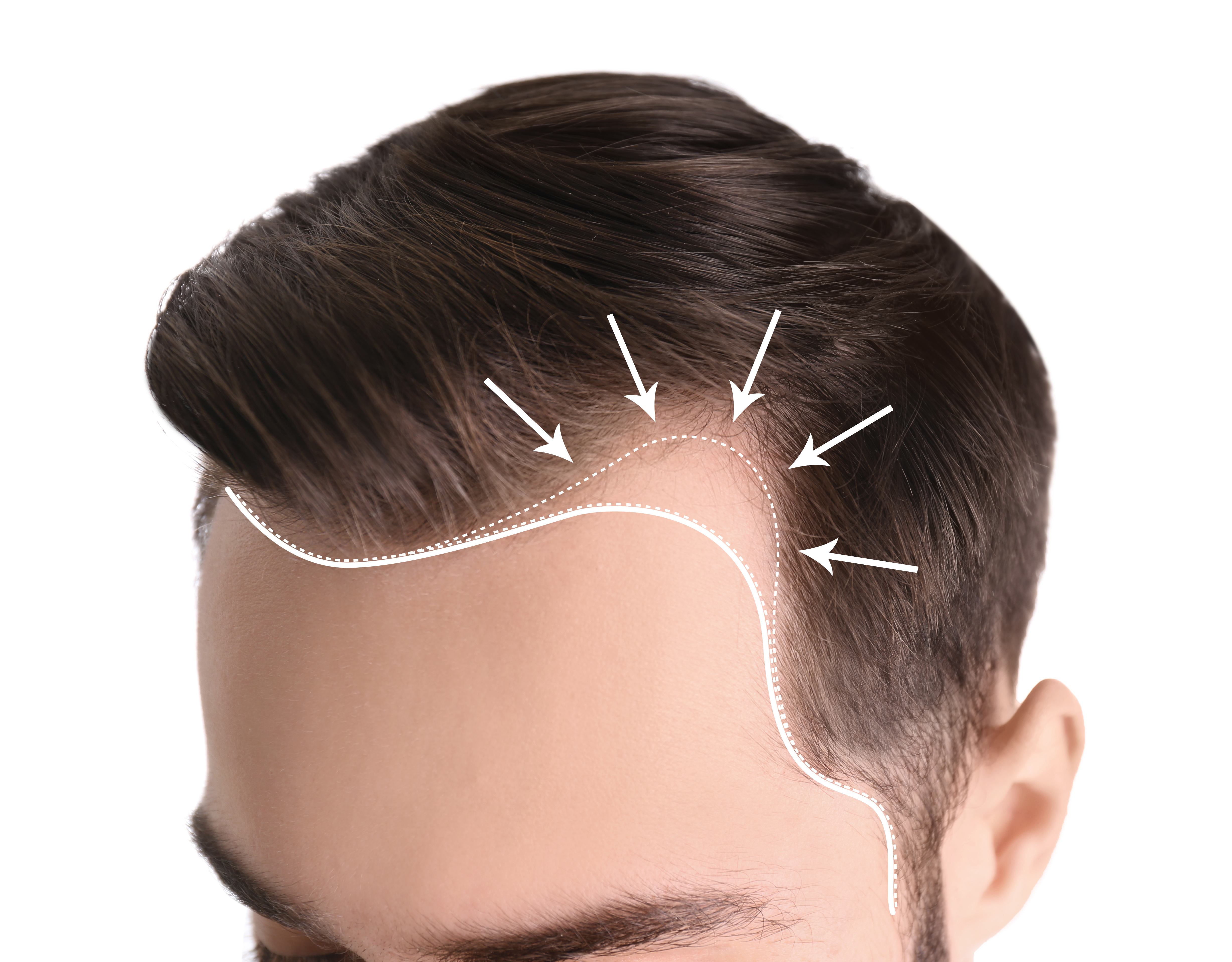 Пересадка волос выпадают волосы. Трихология для мужчин. Линия роста волос у человека.
