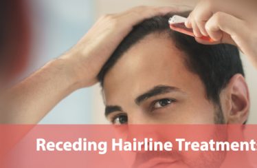 Receding Hairline Treatments