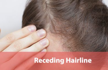 Receding Hairline