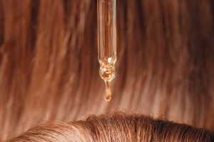 Treating Hair Loss