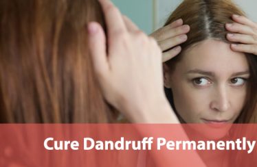 Cure-Dandruff-Permanently