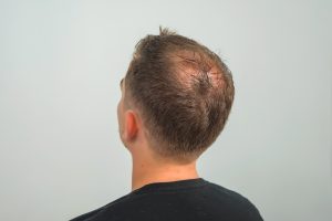 Male Pattern Baldness