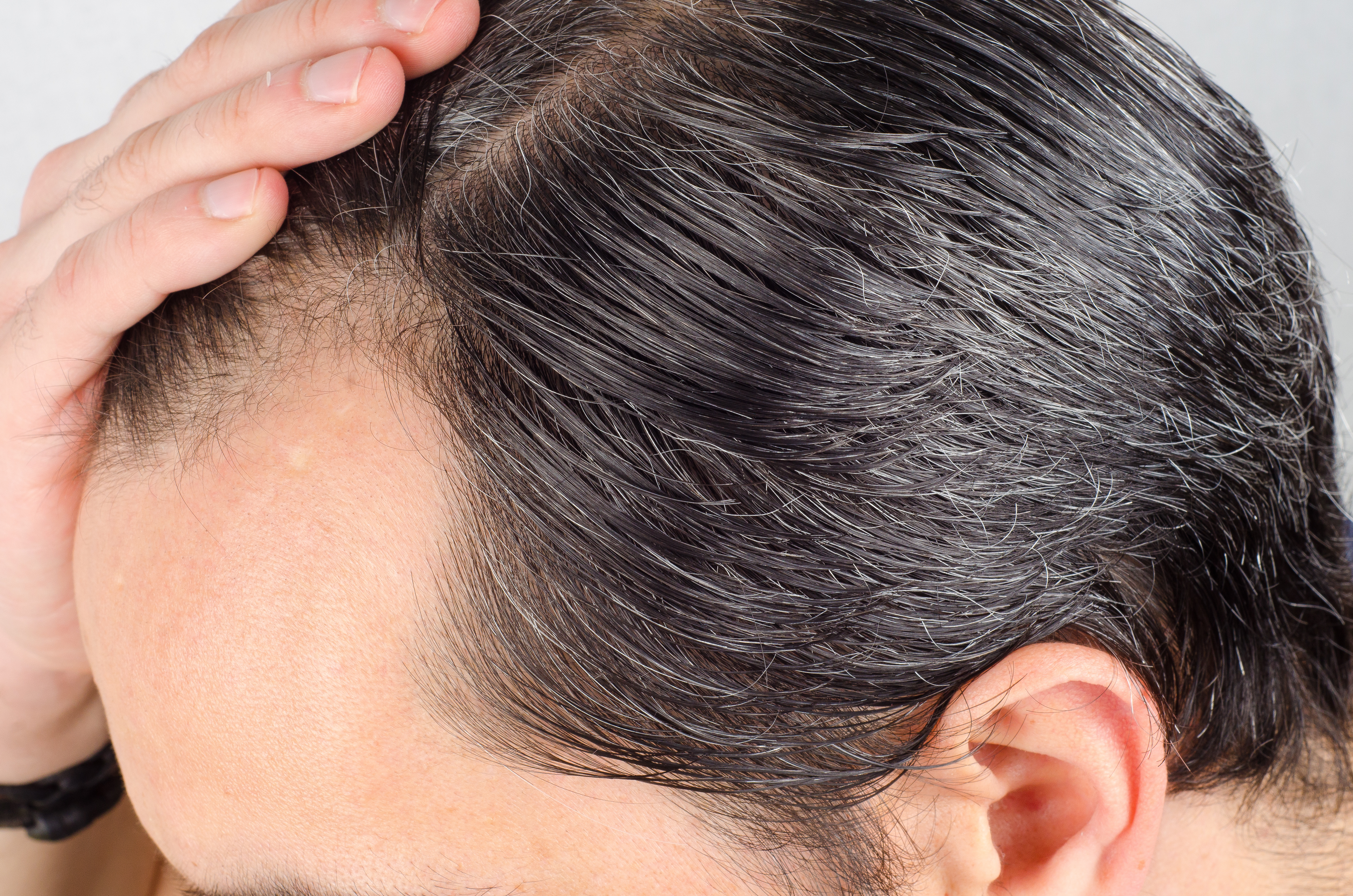 How to keep your hairline from receding