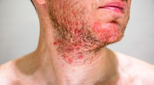 Skin Rashes