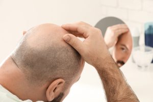 Are You the Right Candidate for A Hair Transplant