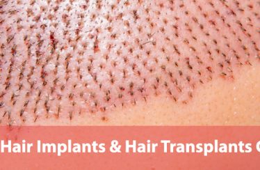 Guide-to-Hair-Plugs-Hair-Implants-&-Hair-Transplants