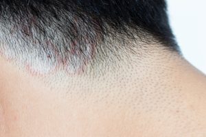 Sebum Buildup Can Cause Infections